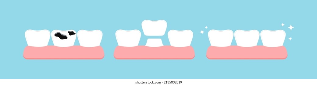 Teeth multiple caries, crown stage in gym before and after dental icon set isolated. Teeth dentistry restoration with ceramic crown in cavity treatment concept. Flat cartoon vector illustration.