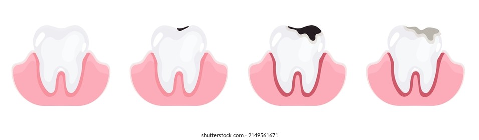 Teeth on different stages of caries. Tooth decay, toothache. Deep caries and pulpits. Flat style vector illustration isolated on white. 