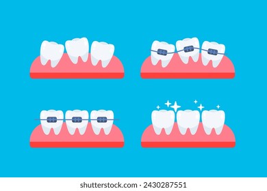 Teeth, orthodontic treatment. Braces on the teeth. Dental care health. Vector illustration