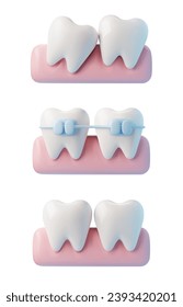 Zähne, kieferorthopädische Behandlung, einzelne realistische 3D-Vektorgrafik auf weißem Hintergrund. Weiße Zähne mit Klammern, Zahnspangen. Zahnbehandlung und Zahnmedizin. Zahnstangenausrichtung vor