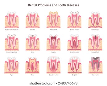 Teeth problems infographic. Human tooth decay, oral cavity problem dentist brochure sensitive teeths care bleed gum caries pulpitis enamel root treatment swanky vector illustration