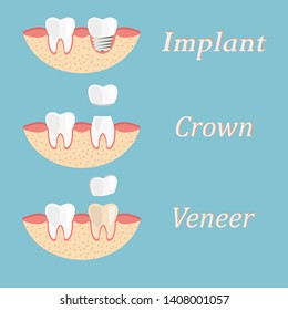 Teeth procedure of implant, crown, veneer restoration. Process stomatology prosthesis