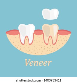 Teeth procedure of veneer restoration. Process stomatology prosthesis vector