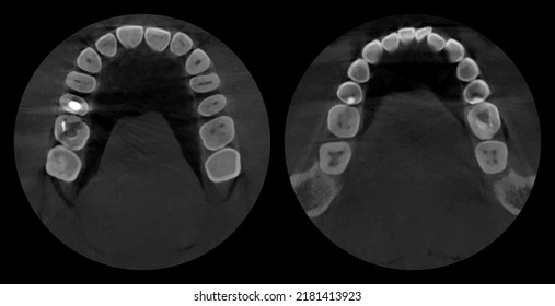 Teeth, realistic 3D scan jaw, dental MRI with caries, scanner picture. Dental x-ray examination graphic, new technologies in dentistry. Vector illustration.