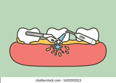 teeth scaling, dental plaque removal for cleaning - tooth cartoon vector flat style cute character for design