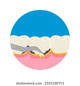 Teeth scaling, dental plaque removal for cleaning and health