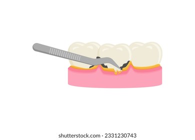 Teeth scaling, dental plaque removal for cleaning and health