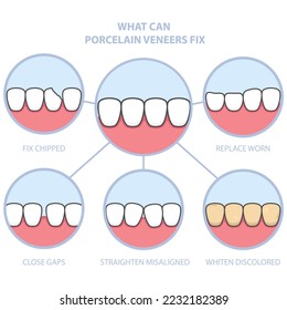 Revestimiento de dientes y sonrisas con cerámica dental, fila de dientes fija con cubierta de barniz, antes y después de dientes, vector