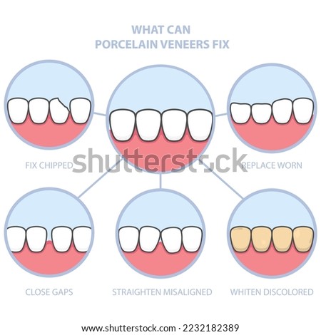 Teeth and smile makeover with dental ceramic veneers, row of teeth fixed with veneer cover, before and after teeth, vector