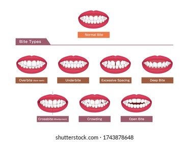 Teeth trouble ( bite type / crooked teeth ) vector illustration set