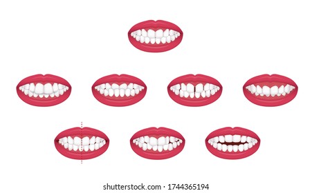 Teeth trouble ( bite type / crooked teeth ) vector illustration set