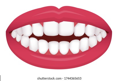 Teeth trouble ( bite type / crooked teeth ) vector illustration /Open bite