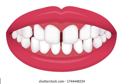 Teeth trouble ( bite type / crooked teeth ) vector illustration /Excessive Spacing