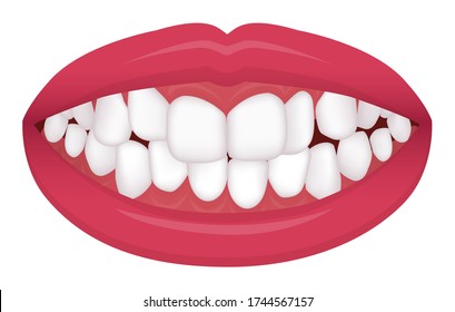 Teeth trouble ( bite type / crooked teeth ) vector illustration /Crowding