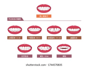 Teeth trouble ( bite type / crooked teeth ) vector illustration set. Translation: Normal bite, Bite types, Overbite, Underbite, Excessive spacing, Deepbite, Crossbite, Crowding, Openbite.