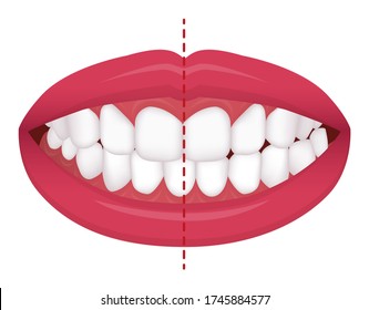 Teeth trouble ( bite type / crooked teeth ) vector illustration  /Crossbite (misalignment)