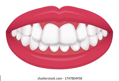 Teeth trouble ( bite type / crooked teeth ) vector illustration /Overbite (Back teeth)