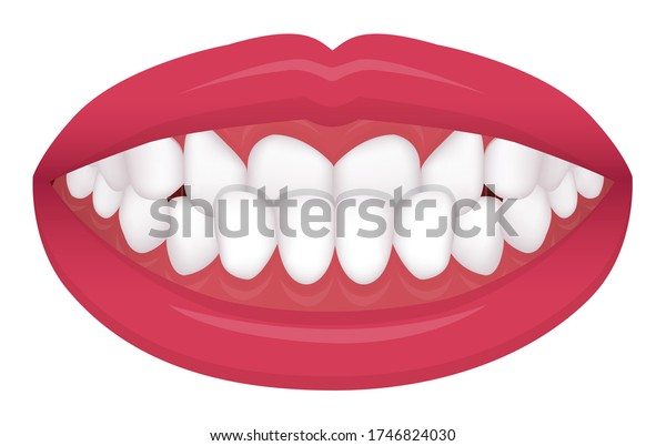 Teeth Trouble Bite Type Crooked Teeth Stock Vector (Royalty Free ...