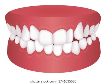 Teeth trouble ( bite type ) vector illustration /Crowding