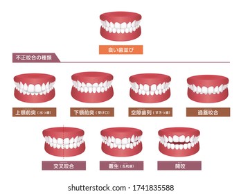 Teeth trouble ( bite type ) vector illustration set. translation: Normal bite, Overbite, Underbite, Excessive Spacing, Deep bite, Crossbite, Crowding, Open bite.