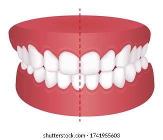 Teeth trouble ( bite type ) vector illustration /Crossbite (misalignment)