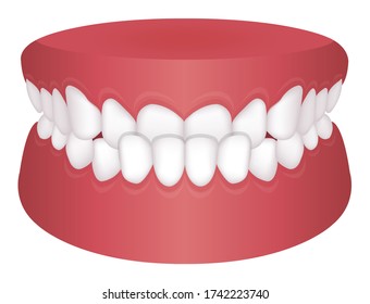 Teeth trouble ( bite type ) vector illustration /Underbite