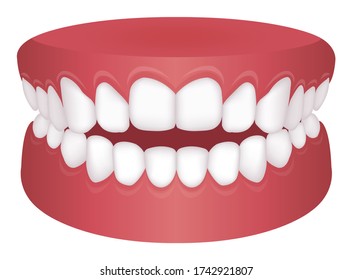 Teeth trouble ( bite type ) vector illustration /Open bite