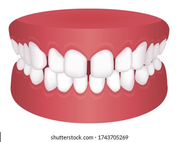 Teeth trouble ( bite type ) vector illustration / /Excessive Spacing