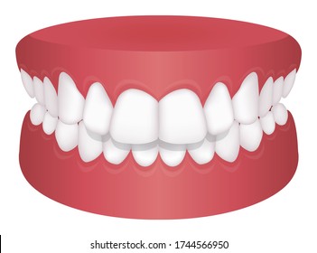 Teeth Trouble ( Bite Type ) Vector Illustration /Overbite (Back Teeth)