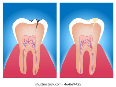 teeth . vector illustration of an amalgam filling before and after .anatomy