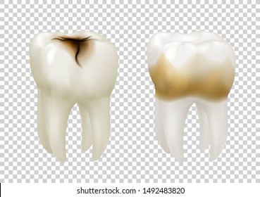 Teeth vector illustration with caries and tooth plaque isolated on transparent background