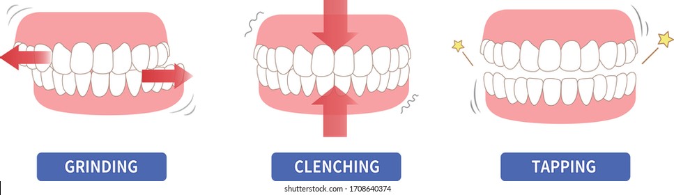 
Teeth wear and TCH stress temporomandibular disorders