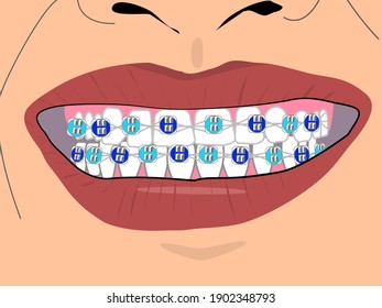 Teeth wearing braces blue and blue