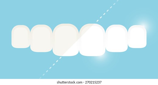 Teeth whitening