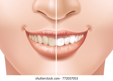 Teeth whitening 3d concept. Comparison of clean and dirty tooth before and after whitening treatment. Oral Care, restoration.