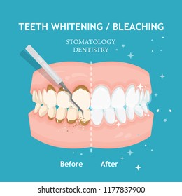 Teeth whitening and bleaching concept. Dentistry and stomatology vector