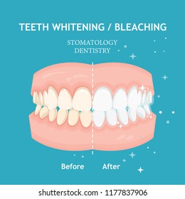 Teeth whitening and bleaching concept. Dentistry and stomatology vector