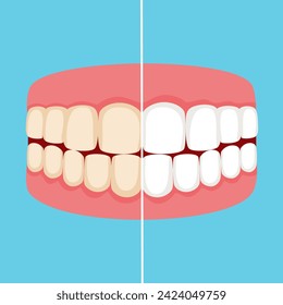 Teeth whitening and bleaching concept. Dentistry and stomatology vector.