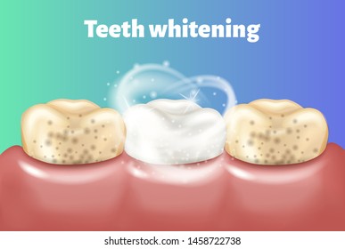 Teeth whitening concept. Tooth before and after whitening. Dirty tooth and other is clean and white. Teeth cleaning realistic 3d vector illustration.