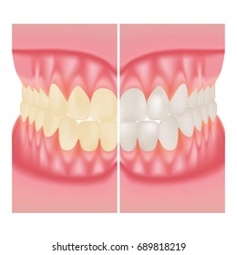 Teeth Whitening. Dental Care. Before And After View Of Teeth Whitening Isolated On A White Background. Vector Illustration. Stomatology. Teeth And Tooth Concept Of Dental