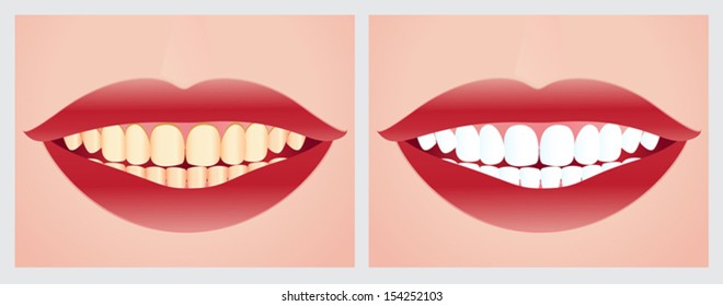 Teeth whitening. File is not flattened with labeled layers. Easy to add.