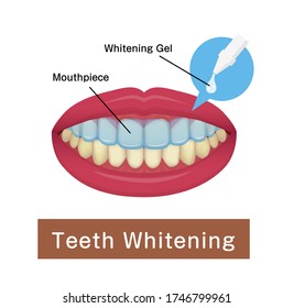 Teeth Whitening At Home Vector Illustration