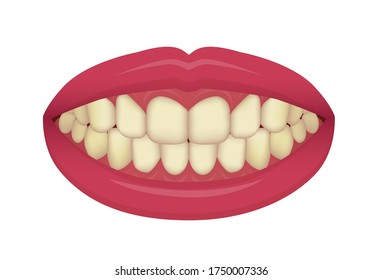 Teeth whitening at home vector illustration / yellowed teeth