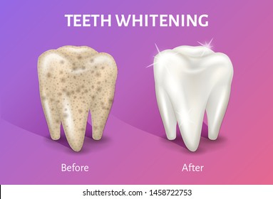 Teeth whitening in realistic 3d vector illustration. Teeth cleaning concept. Tooth before and after whitening. First tooth is dirty, other is clean and white.