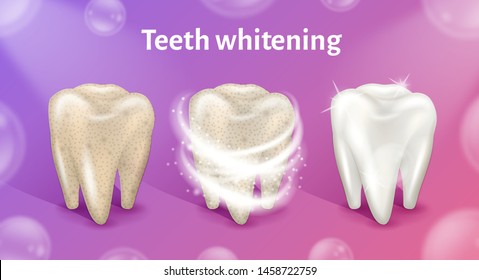 Teeth whitening in realistic 3d vector illustration. Teeth cleaning concept. Tooth before, in process and after whitening. First tooth is dirty, other is clean and white.