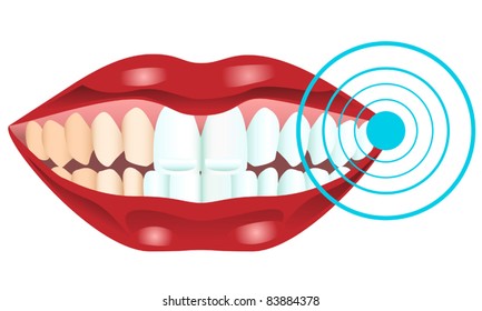 Teeth whitening, vector illustration
