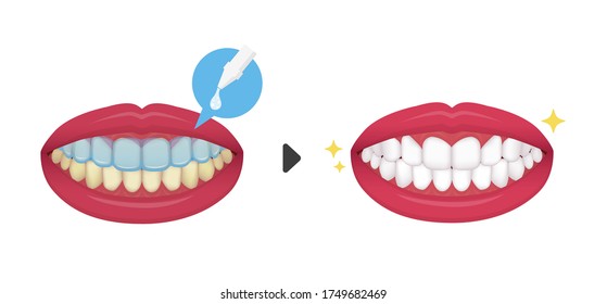 Teeth whitening vector illustration / before and after