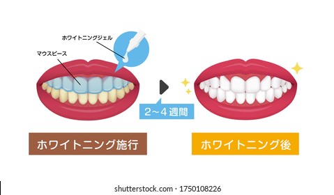 Teeth whitening vector illustration / before and after.  Translation: Whitening gel, Mouthpiece, 2-4 weeks, Before whitening,  After whitening.