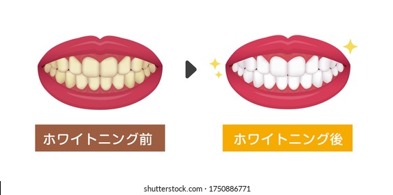 Teeth whitening vector illustration / before and after.  Translation: Before whitening,  After whitening.