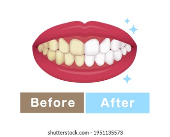 Ilustración vectorial de blanqueamiento de dientes | antes y después 